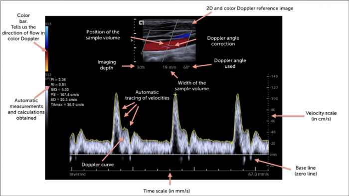 6-spectral-doppler-123-sonography